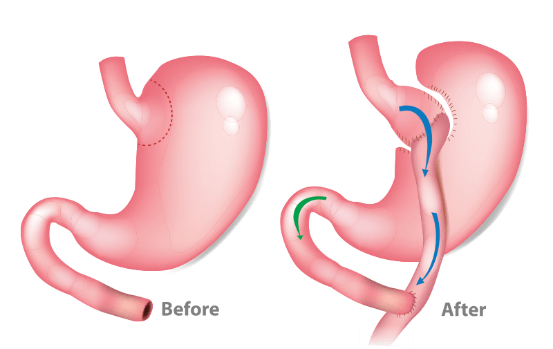 Gastrico BYPASS